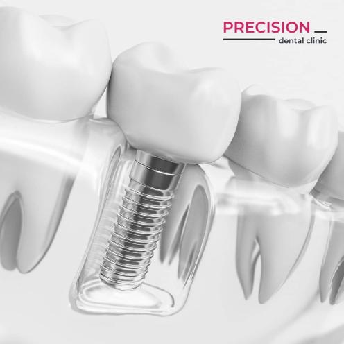 Precision Dental Clinic