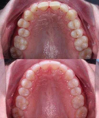 Apex Dent