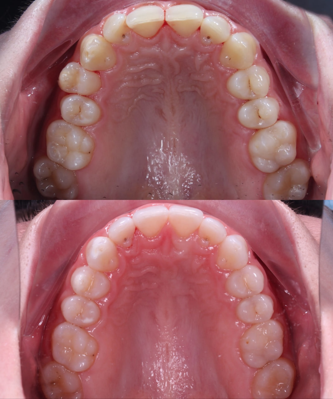 Apex Dent
